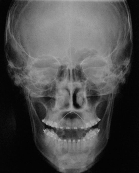 antero-posterior